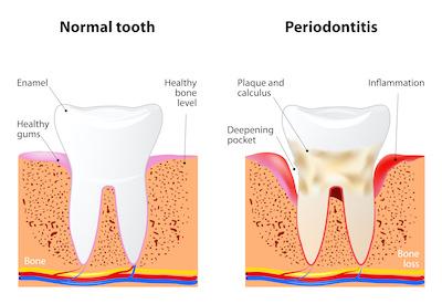 Before and after gum disease treatment in moorabbin