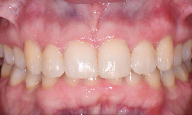 after invisalign treatment at Bayside Smiles
