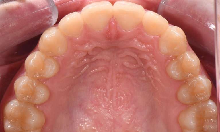 Alignment of top teeth after Invisalign in black rock