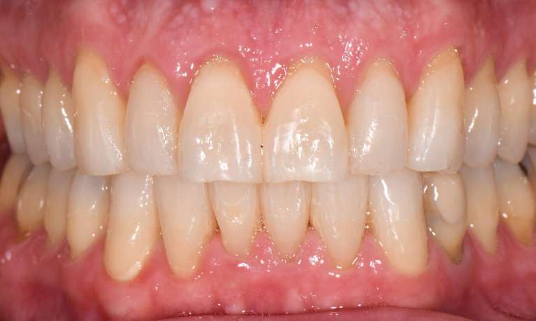 smile after orthodontic treatment with Invisalign