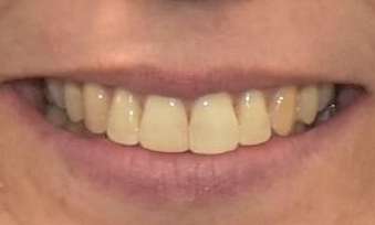 patient after Invisalign treatment in black rock