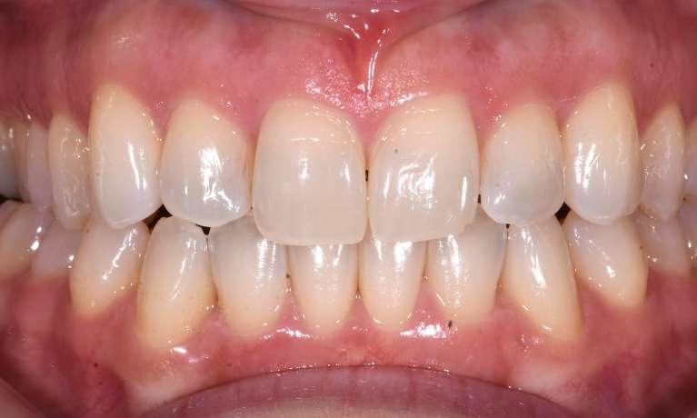 after photo for Invisalign treatment in black rock, vic