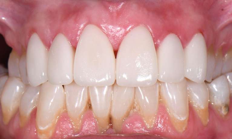 veneers teeth whitening black rock