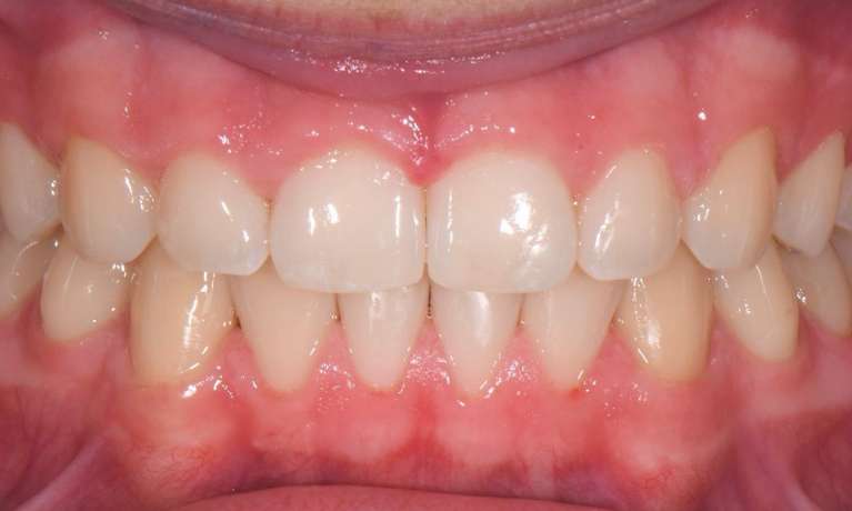 after Invisalign treatment in Black Rock