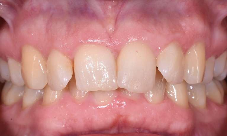before invisalign treatment at Bayside Smiles