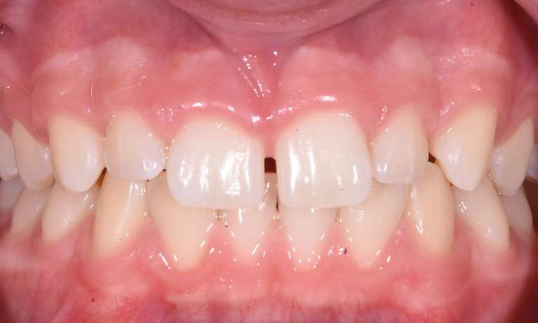 before Invisalign treatment in Black Rock