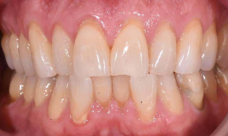 smile before orthodontic treatment with Invisalign