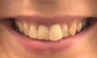patient before Invisalign treatment in black rock