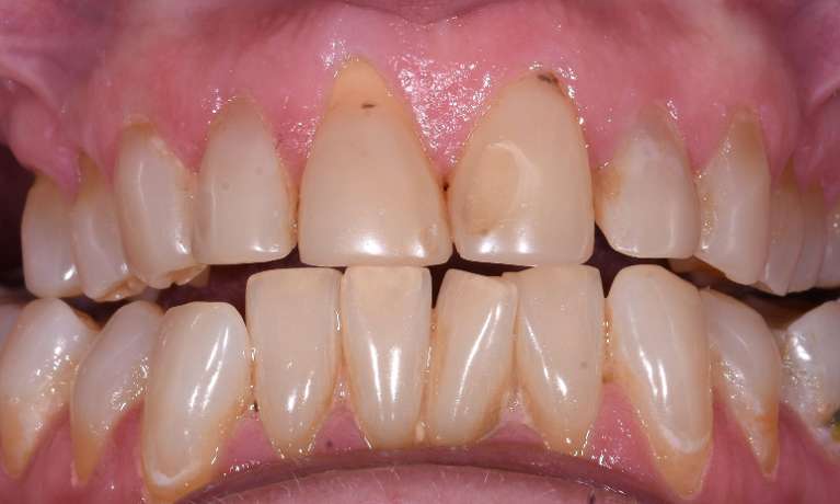 teeth whitening veneers black rock